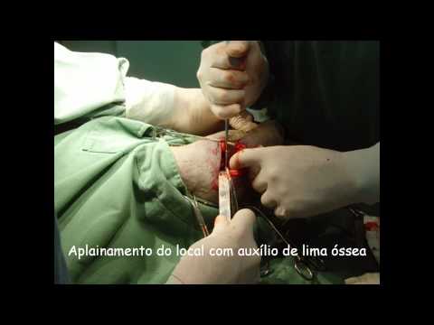 Colocefalectomia no cão / Ostectomy of the femoral head and neck in the dog