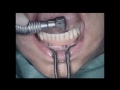 Seattle All on Four Dental Implants Lance Timmerman DMD