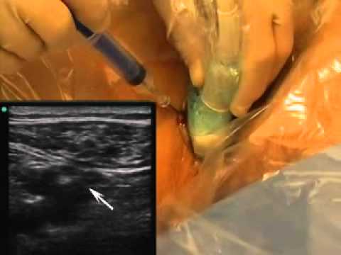 how to locate femoral vein