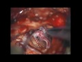 Brain Aneurysm Surgery