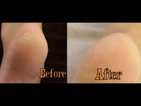 how to treat cracked feet