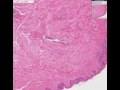 Histopathology Breast--Paget disease