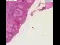 Histopathology Breast--Paget disease Histopathology Breast--Paget disease