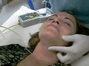 carboxterapia carboxterapia