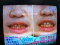 Cleaning up that binlang smile....