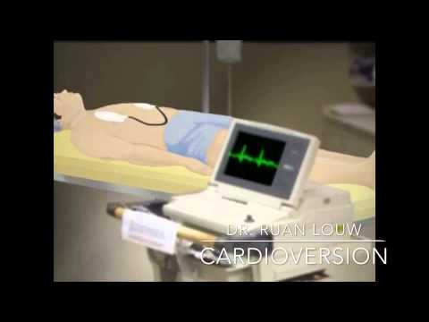 how to perform dc cardioversion