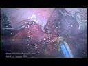 SCARLESS Single Incision/Single Port Laparoscopic Supracervical Hysterectomy