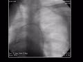 Missing Link from Aorta Missing Link from Aorta
