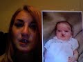 Cleft Lip & Palate 
