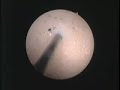 Bladder and prostate injection- Botox