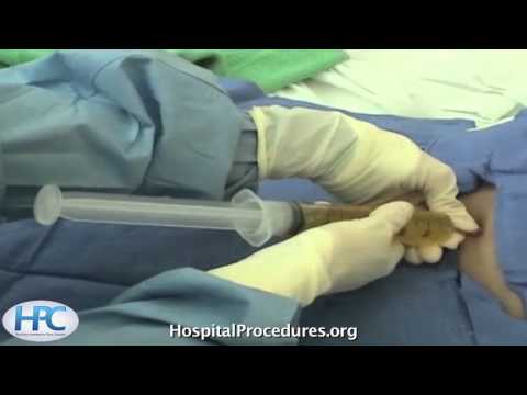 how to perform paracentesis
