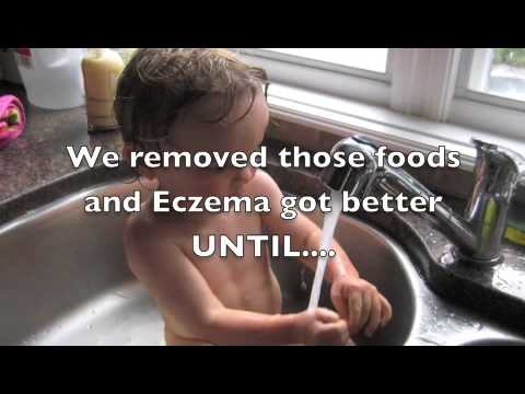 how to avoid eczema by food