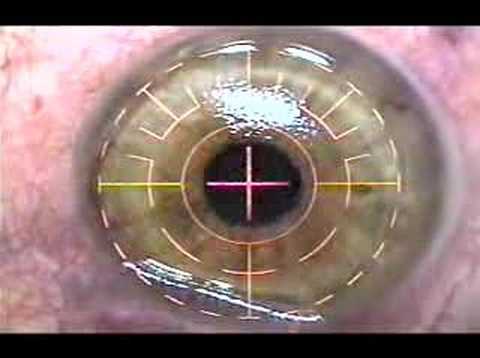 Young woman undergoes Lasik to ...