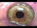 Young woman undergoes Lasik to correct near-sightedness