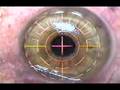 Young woman undergoes Lasik to correct near-sightedness