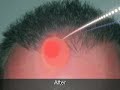 Hair Loss Hair Restoration Surgery Hair Loss Hair Restoration Surgery