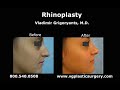 Los Angeles rhinoplasty by Dr. Vladimir Grigoryants, Nose surgery Beverly Hills Pasadena Los Angeles rhinoplasty by Dr. Vladimir Grigoryants, Nose surgery Beverly Hills Pasadena