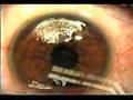 Lasik