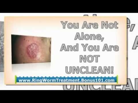 how to cure ringworm in humans