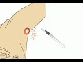 Lump in armpit video (Its Educational) Lump in armpit video (Its Educational)