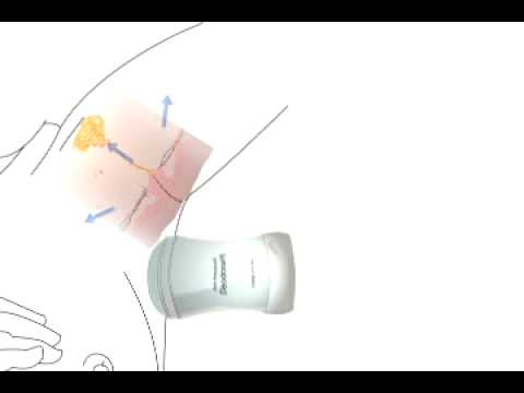 how to relieve underarm cyst pain