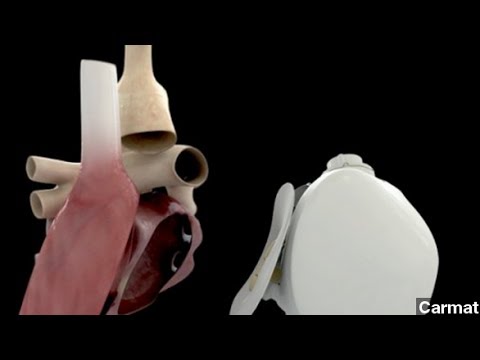 how to transplant a human heart