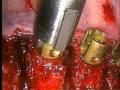 Endoscopic Anterior Thoracic Spinal Instrumentation & Fusion for Idiopathic Scoliosis