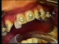 Nivelaci�n