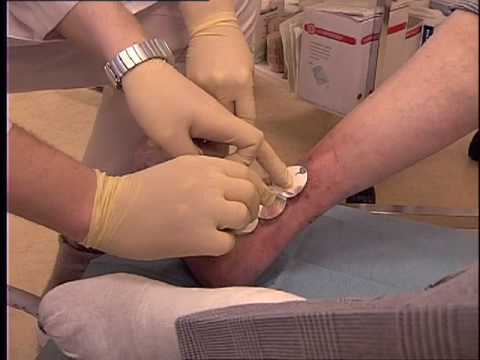 Antibakterielle Kompressen beschleunigen Wundheilung