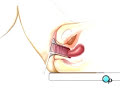 PreOp® Patient Education: Dilation and Curettage D and C pt1 Dilation And Curettage