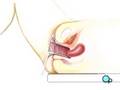 PreOp-Patient-Educat