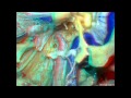 Far Lateral Approach and Jugular Foramen (3D) - Part 2 of 2