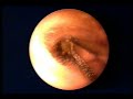 Detailed ear cleaning