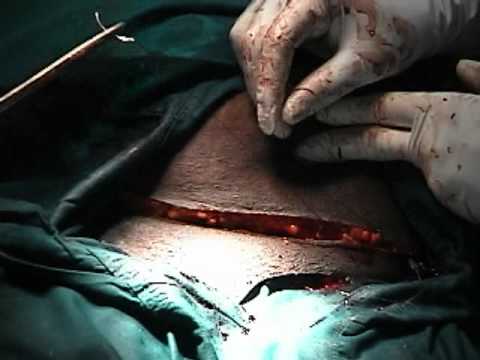 how to treat hematoma after c section