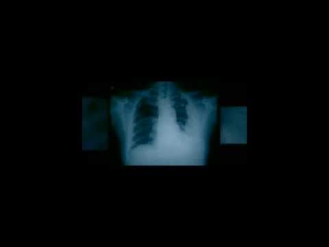 Georgia Mesothelioma Lawyer _ Choosing an Abestos Lawsuit Attorney in Georgia