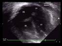 Anomalous Pulmonary Venous Return-Partial