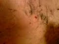 max gets his chest and back hair removed part two removel