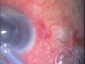 videos de Phaco, leaky bleb during procedure, use cayanoacrylate-1
