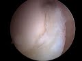 Torn Labrum #2