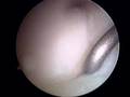 Torn Labrum #2