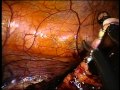 Nephrectomy - Laparoscopic Endoscopic Single-Site Surgery (LESS) Nephrectomy - Laparoscopic Endoscopic Single-Site Surgery (LESS)