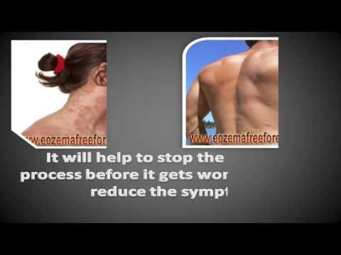 how to treat irritant contact dermatitis