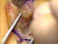 Live Webcast: Carpal Tunnel Release