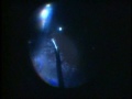 Giant Retinal Tear