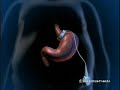 Mide kelep�esi (Ayarlanabilir silikon gastrik band) yerle?tirilmesi animasyon
