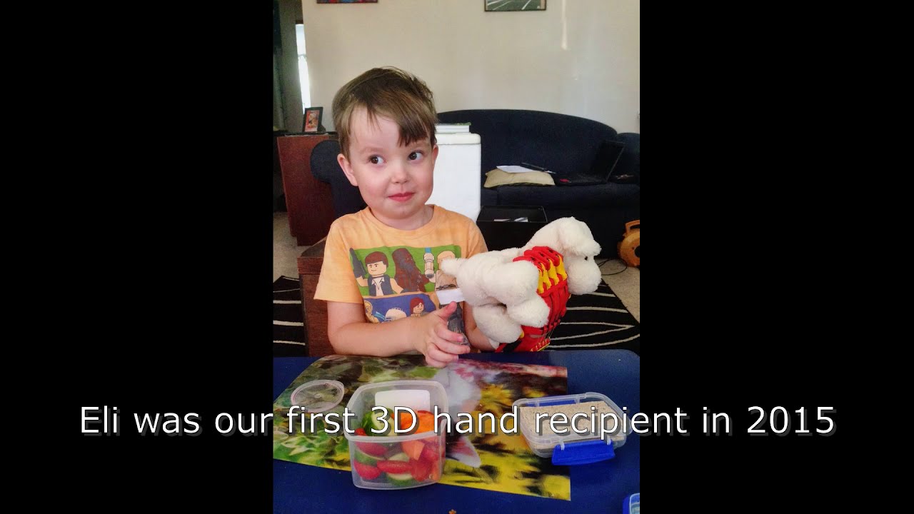 Eli receiving two new Kinetic Hands!