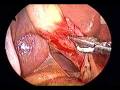 Totally Transumbilical laparoscopic cholecystectomy