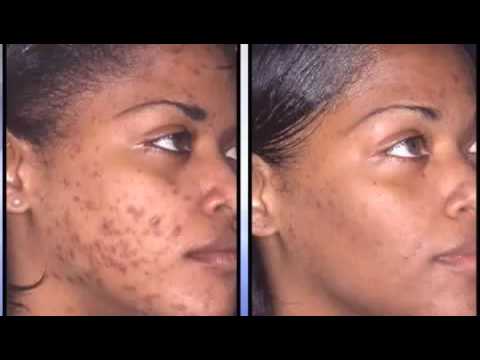How To: Get Rid of Acne/Dark Spots and Scars