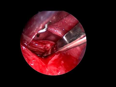 how to drain retropharyngeal abscess