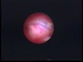 Epiduroscopy - Intervention: disc surface Epiduroscopy